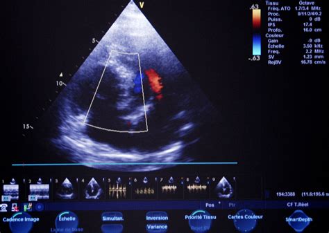 dupple|qué es una ecografía doppler.